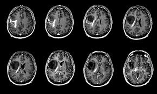 Epilepsi Belirtileri Neden Olur Nasıl Anlaşılır Tedavisi İlaçları Epilepsi Belirtileri Neden Olur Nasıl Anlaşılır Tedavisi İlaçları