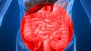 Bağırsak Tümörü Belirtileri ve Tedavisi