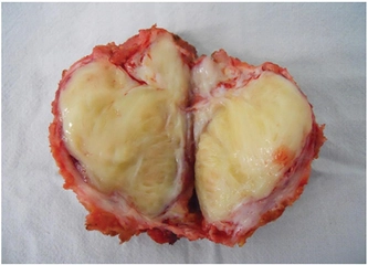 Desmoid Tümör Belirtileri ve Tedavisi
