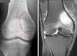 Dev Hücreli Tümör Belirtileri ve Tedavisi