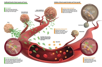 Gastrointestinal Stromal Tümör