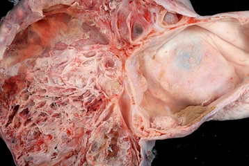 Tümör Belirtileri ve Tedavisi