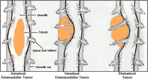 Omurilik Tümörü Belirtileri ve Tedavisi