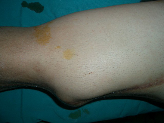 Bacakta Tümör Belirtileri ve Tedavisi