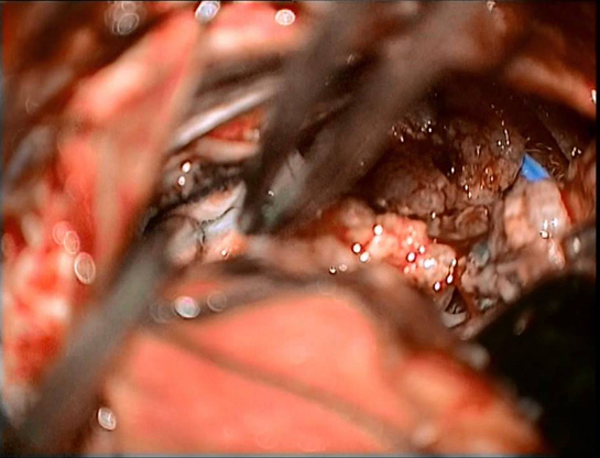 Beyin Tümörü Ameliyatı Riskleri ve Sonrası