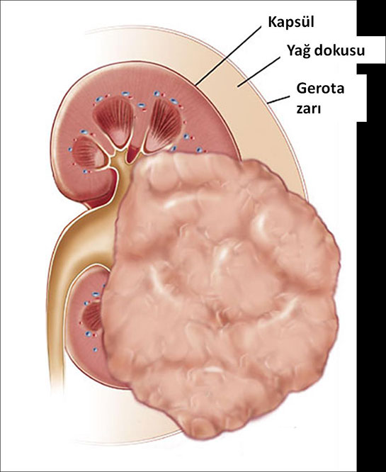 Böbrek Tümörü Belirtileri ve Tedavisi