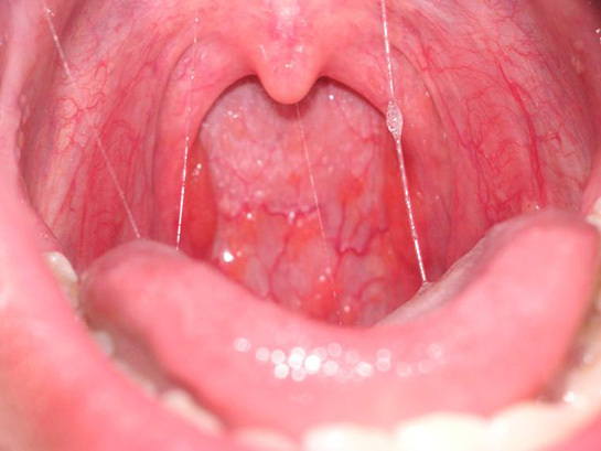 Boğaz Tümörü Belirtileri ve Tedavisi