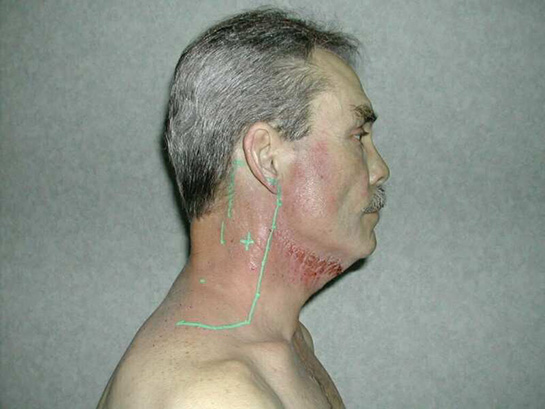 Boyun Tümörleri Belirtileri ve Tedavisi