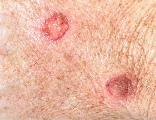 Cilt Tümörü Belirtileri ve Tedavisi