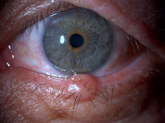 Gözde Tümör Belirtileri ve Tedavisi