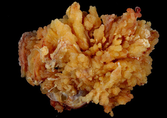 Habis Tümör Belirtileri ve Tedavisi