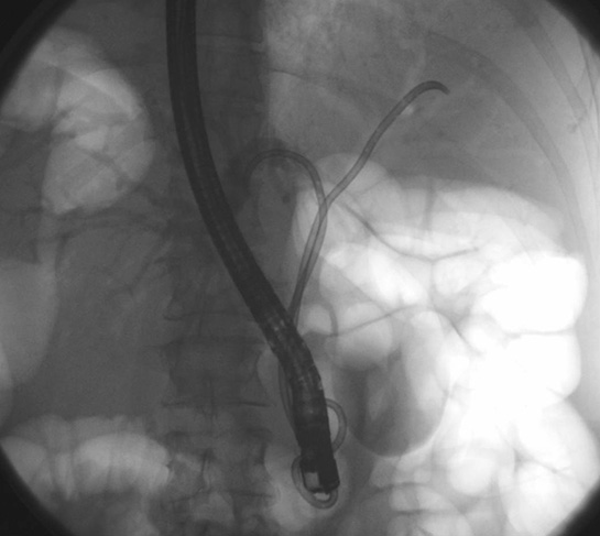 Klatskin Tümörü Belirtileri ve Tedavisi