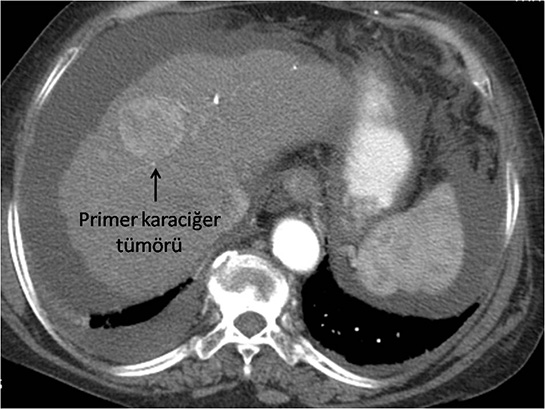 Karacier Tmrleri