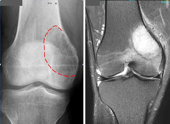 Kemik Tümörü Belirtileri ve Tedavisi