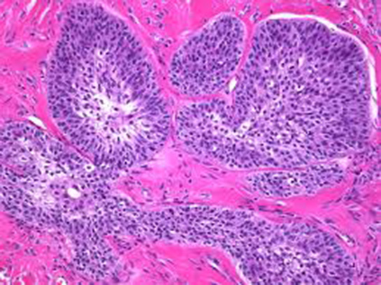 Malign Tümör Belirtileri ve Tedavisi