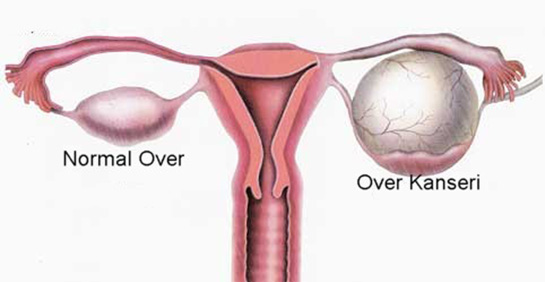 Over Tümörleri Belirtileri ve Tedavisi